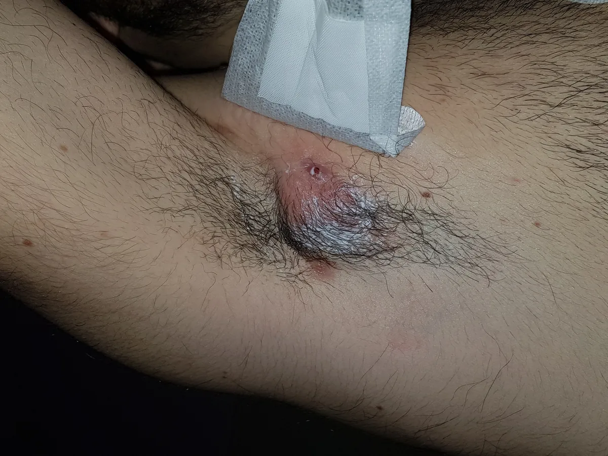 Armpit with a large inflamed nodule from Hidradenitis Suppurativa at onset